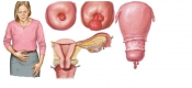 Polyp Cổ tử cung Polyp Cổ tử cung