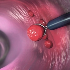 Polyp Dạ Dày Có Nguy Hiểm Không? Khi Nào Cần Cắt Bỏ?