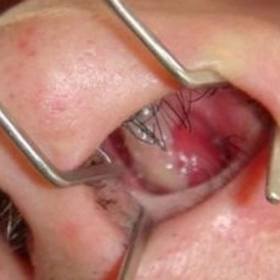Polyp Mũi Là Gì? Nguyên Nhân, Triệu Chứng Và Cách Điều Trị