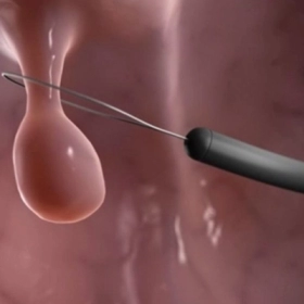 Polyp Nội Mạc Tử Cung: Nhận Biết Sớm Để Tránh Biến Chứng