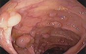 Polyp trực tràng Polyp trực tràng