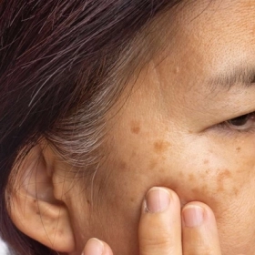 Rám Má Có Chữa Được Không? Giải Pháp Hiệu Quả 