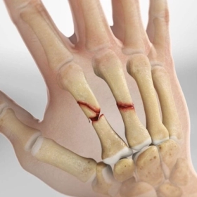 Rạn Xương Là Gì? Dấu Hiệu, Nguyên Nhân Và Cách Xử Lý Đúng Chuẩn Y Khoa