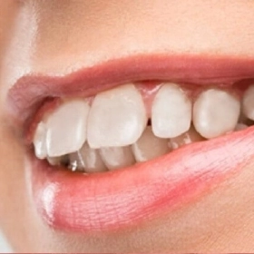 Răng Hô Là Gì? Nguyên Nhân, Dấu Hiệu Và Cách Điều Trị