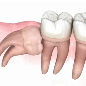Răng Mọc Kẹt Là Gì? Nguyên Nhân, Dấu Hiệu Và Cách Điều Trị