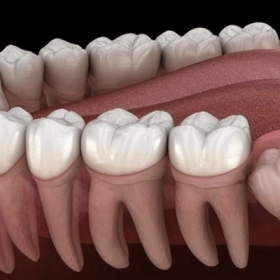 Răng Mọc Ngầm Có Nguy Hiểm Không? Những Điều Cần Biết