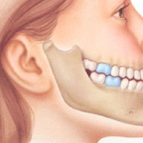 Răng Móm Là Gì? Nguyên Nhân, Dấu Hiệu Và Cách Điều Trị