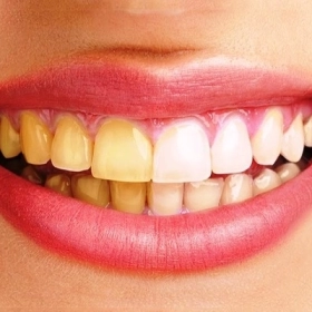 Răng Ố Vàng: Nguyên Nhân Thường Gặp Và Giải Pháp Cải Thiện