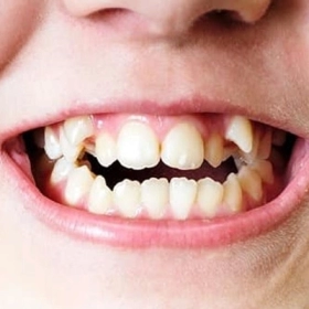 Răng Thừa Là Gì? Nguyên Nhân, Dấu Hiệu Và Cách Điều Trị