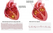 Rối loạn nhịp tim Rối loạn nhịp tim