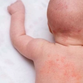 Rôm sảy là gì? Nguyên nhân, phân loại và bí quyết điều trị dứt điểm