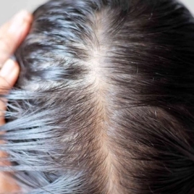 Rụng Tóc Hậu COVID: Nguyên Nhân Và Cách Khắc Phục An Toàn