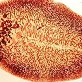 Sán Lá Phổi Là Gì? Triệu Chứng, Nguyên Nhân Và Cách Phòng Ngừa Hiệu Quả