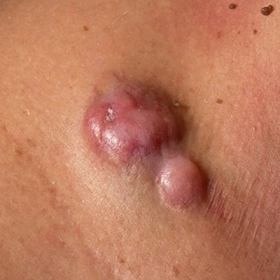 Sarcoma Mạch Máu Là Gì? Nguyên Nhân, Triệu Chứng Và Cách Điều Trị