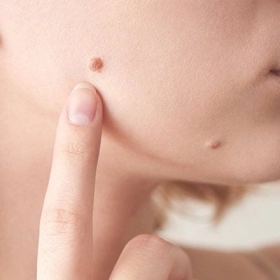 Sau Khi Tẩy Nốt Ruồi Bị Sẹo Lõm Phải Làm Sao? Giải Pháp Hiệu Quả