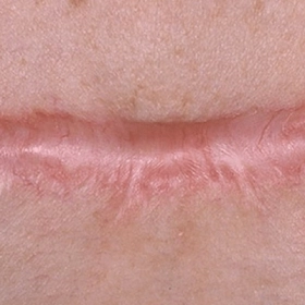 Sẹo Lồi Là Gì? Nguyên Nhân Hình Thành Và Cách Phòng Ngừa Hiệu Quả