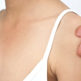 Sẹo Phì Đại Là Gì? Nguyên Nhân, Triệu Chứng Và Cách Điều Trị