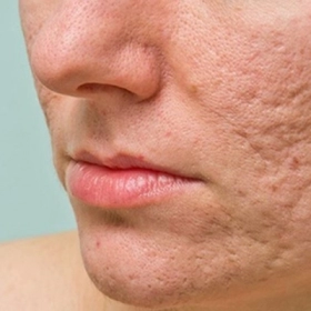 Sẹo Rỗ Là Gì? Nguyên Nhân Và Cách Điều Trị Hiệu Quả Nhất Hiện Nay