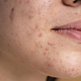 Sẹo Thâm Là Gì? Nguyên Nhân, Cách Điều Trị Và Phòng Ngừa Hiệu Quả