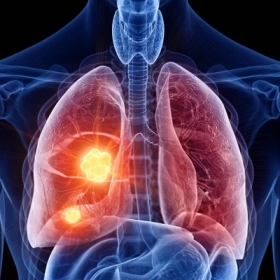 Sevabertinib Là Gì? Công Dụng, Cơ Chế Và Lưu Ý Khi Sử Dụng