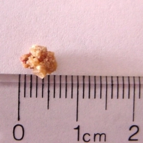 Sỏi Niệu Quản Là Gì? Dấu Hiệu Nhận Biết Và Cách Điều Trị Hiệu Quả