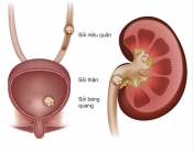 Sỏi tiết niệu Sỏi tiết niệu