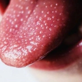 Sốt Tinh Hồng Nhiệt Là Gì? Nguyên Nhân, Triệu Chứng Và Cách Điều Trị