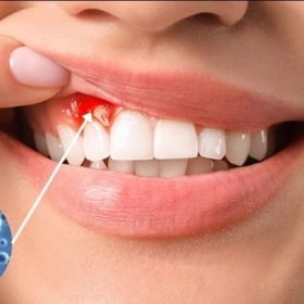 Sưng nướu Là Gì? Nguyên Nhân, Triệu Chứng Và Cách Điều Trị
