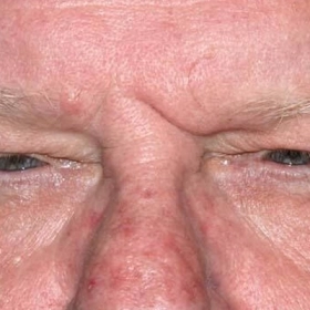 Sụp Mí Mắt Ở Người Lớn Tuổi: Nguyên Nhân Và Cách Khắc Phục