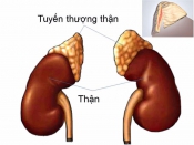 Suy thượng thận Suy thượng thận