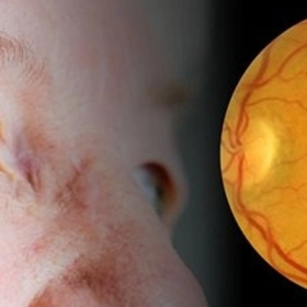 Tắc Động Mạch Võng Mạc Trung Tâm Có Nguy Hiểm Không?