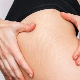 Tại Sao Bị Rạn Da Ở Tuổi Dậy Thì? Nguyên Nhân Và Cách Phòng Ngừa