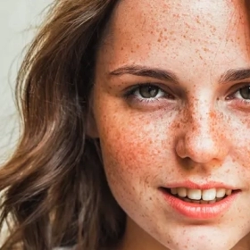 Tại Sao Da Xuất Hiện Tàn Nhang? Những Yếu Tố Nguy Cơ Bạn Cần Biết