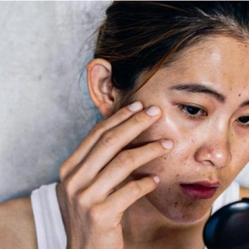 Tại sao không ra nắng mà da vẫn đen? 7 nguyên nhân bạn cần biết
