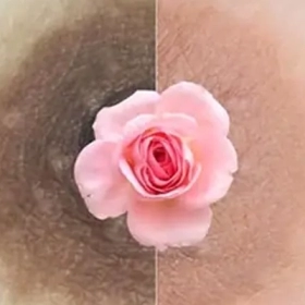 Tại Sao Nhũ Hoa Bị Thâm Ở Tuổi Dậy Thì? Nguyên Nhân Và Cách Chăm Sóc