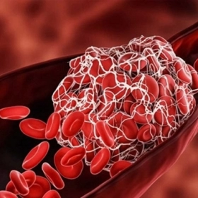 Tăng Áp Lực Động Mạch Phổi Là Gì? Nguyên Nhân, Triệu Chứng Và Điều Trị