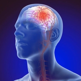 Thiểu năng tuần hoàn não: Triệu chứng, nguyên nhân và cách xử lý