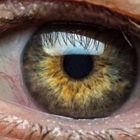 Thoái Hóa Điểm Vàng: Nguyên Nhân, Triệu Chứng Và Cách Điều Trị