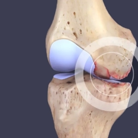 Thoái Hóa Khớp: Nguyên Nhân, Triệu Chứng Và Cách Điều Trị