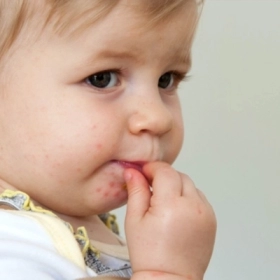 Thuốc Bôi Tay Chân Miệng: Nên Dùng Loại Nào An Toàn Cho Trẻ?