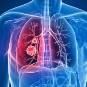 Thuyên Tắc Động Mạch Phổi Là Gì? Nguyên Nhân, Triệu Chứng Và Cách Điều Trị Hiệu Quả