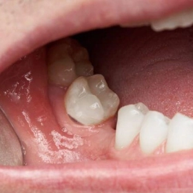 Tiêu Chân Răng Là Gì? Nguyên Nhân, Dấu Hiệu Và Cách Điều Trị