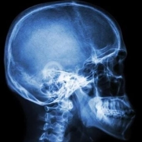 Tiêu Xương Sọ: Nguyên Nhân, Triệu Chứng Và Hướng Điều Trị Hiện Nay