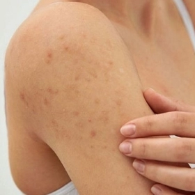 Top Phương Pháp Điều Trị Viêm Lỗ Chân Lông Tại Nhà An Toàn, Tiết Kiệm