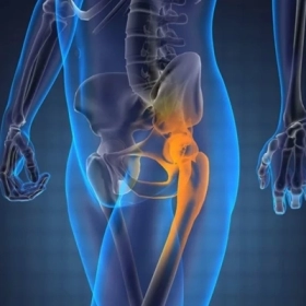 Trật Khớp Hông: Nguyên Nhân, Triệu Chứng, Cách Điều Trị Và Phục Hồi Hiệu Quả