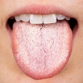 Tưa Lưỡi (Nấm Miệng Do Candida): Nguyên Nhân, Dấu Hiệu Và Cách Trị