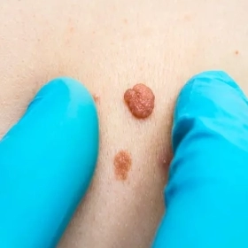 U mềm treo: Nguyên nhân, dấu hiệu và các phương pháp điều trị an toàn