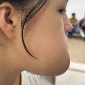 U Men Xương Hàm Là Gì? Nguyên Nhân, Triệu Chứng Và Cách Điều Trị