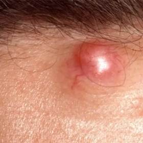 U Nang Biểu Bì Là Gì? Nguyên Nhân, Triệu Chứng Và Cách Điều Trị 