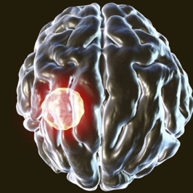 U nang màng nhện: Dấu hiệu, nguyên nhân và điều trị hiệu quả